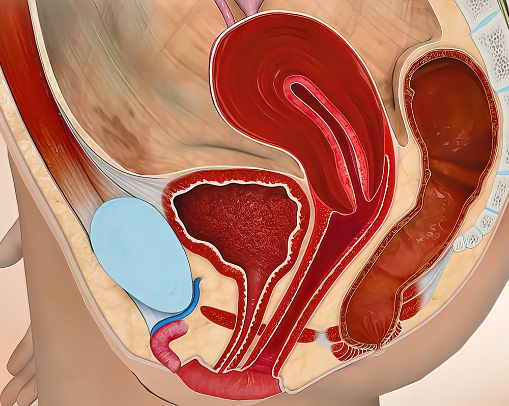子宫内膜增生症
